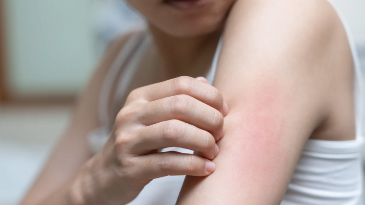 Acne and Rash Urgent Dermatology Visit Near Dunkirk MD